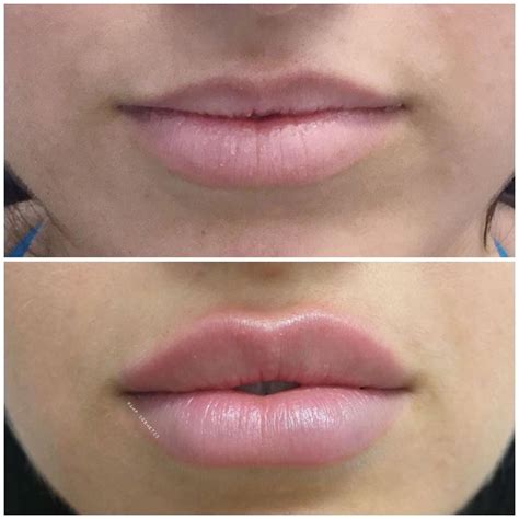 What Is Lip Filler Made Of