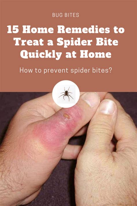 15 Home Remedies to Treat a Spider Bite Quickly at Home | Spider bites, Treating spider bites ...