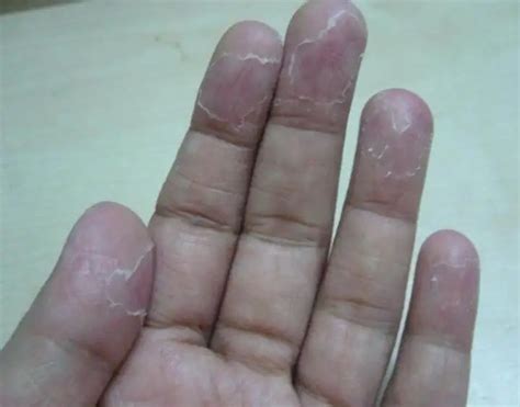 8 Main Causes of Peeling Skin on Your Fingers