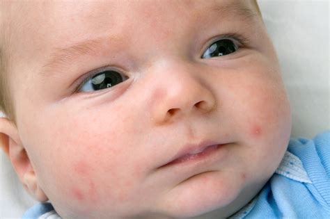 5 Common Baby Skin Allergies