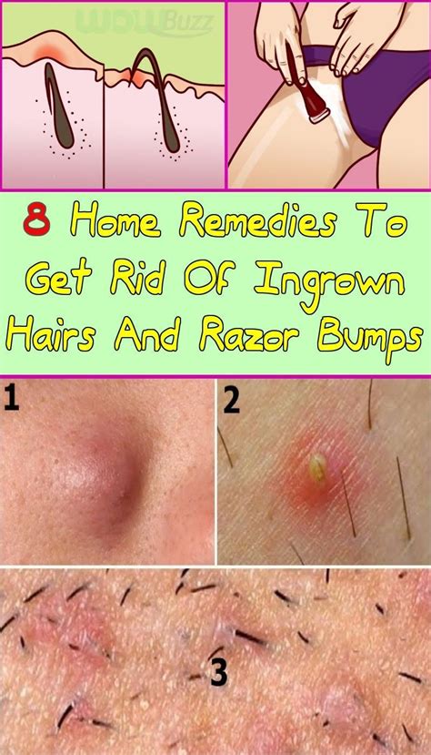 #BiotinAndHairLoss | Skin bumps, Treat ingrown hair, Ingrown hair remedies