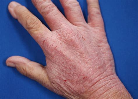 Eczema On Hands Types