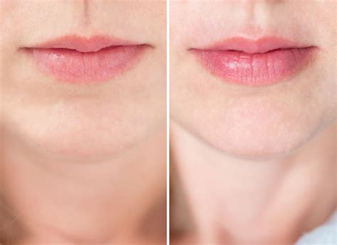Reviewed: The PMD Kiss Lip Plumping System for Fuller-Looking Lips (No Injections Required ...