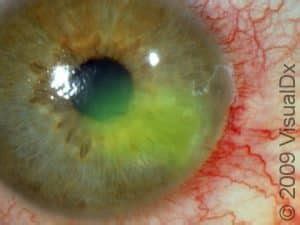 Recurrent Corneal Erosion: Causes, Symptoms, and Treatment