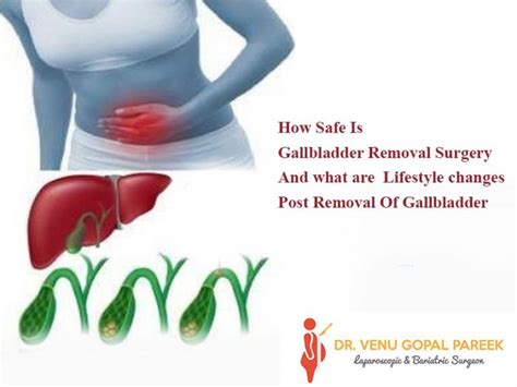 How Safe Is Gallbladder Removal Surgery And what are Lifestyle changes ...