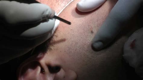 Nevus Removal by Laser - Dr Reza Yazdanpanah, Malmö, Sweden, 2013 - YouTube