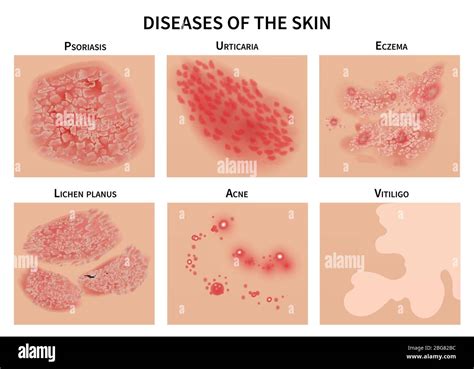 Skin diseases. Derma infection, eczema and psoriasis. Dermatology vector illustration. Disease ...