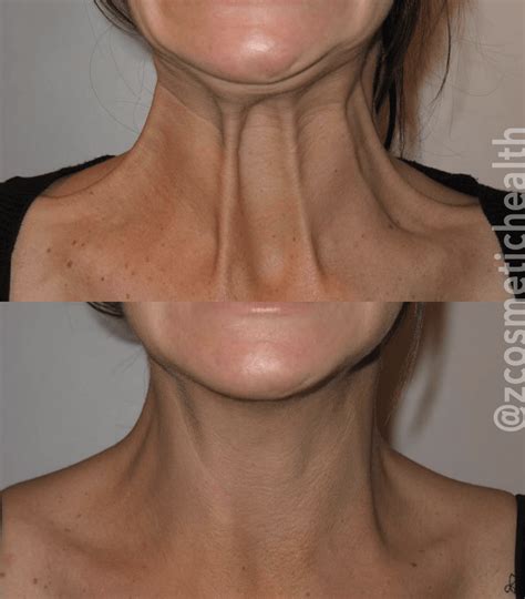 Fat Neck Wrinkles