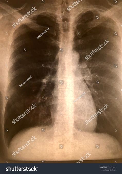 Xray Males Torso Showing Rib Cage Stock Photo 779571091 | Shutterstock