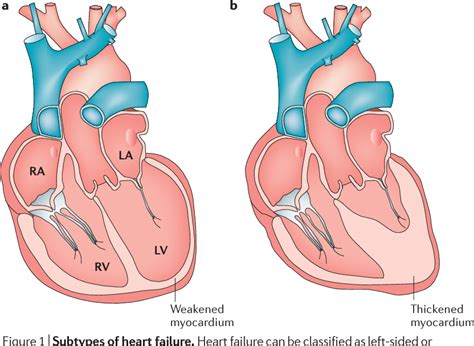 [PDF] Heart failure with reduced ejection fraction | Semantic Scholar