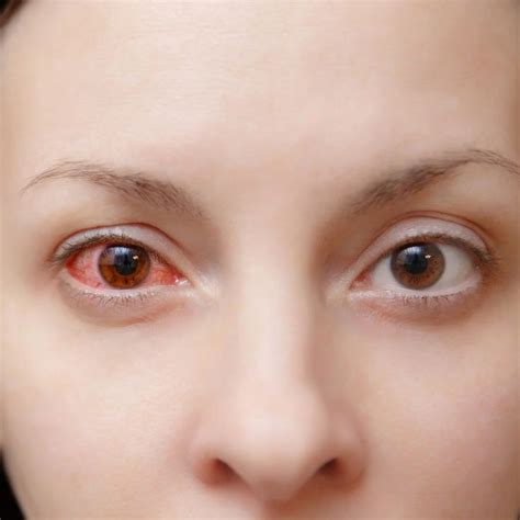 Pink Eye Home Remedies, Natural Pink Eye Remedy, Natural Healing, Pink Eye Essential Oils, Red ...