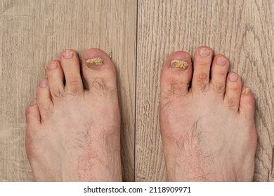 5,187 Ugly Toes Images, Stock Photos, 3D objects, & Vectors | Shutterstock