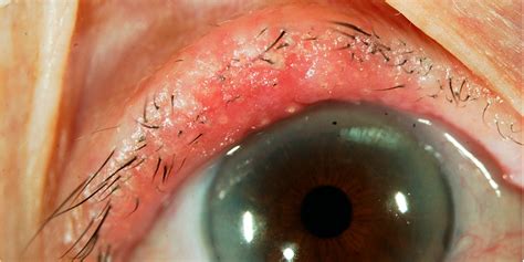 Skin Cancer On Eyelid Symptoms