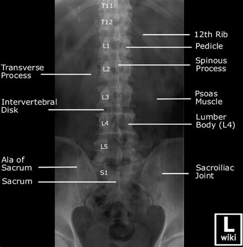 In this image, you may find Lumbar Spine Anterior Posterior View On X-ray With Labeled ...