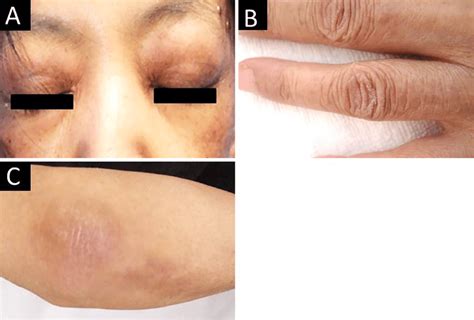 Figure1.Skin rashes of the patient. Heliotrope rash (A) and Gottron's... | Download Scientific ...