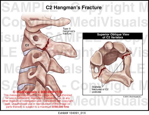 C2 Hangman's Fracture Medical Illustration Medivisuals