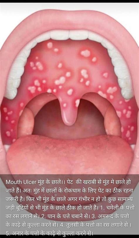 Aphthous ulcers aphthae in the mouth causes and treatments – Artofit