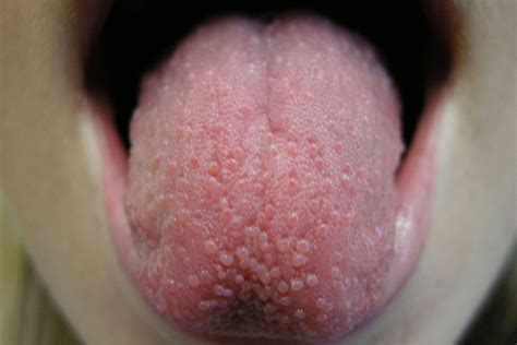 Pimple on Tongue? Understanding Causes, Treatment, and Prevention of Tongue Bumps - Dental ...