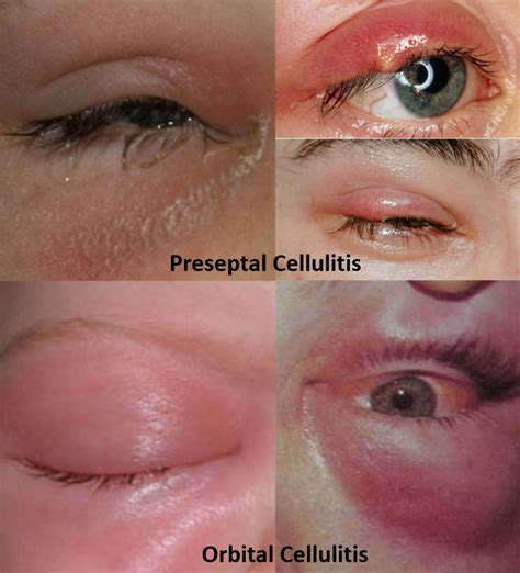 Swollen Eyelid - Know the causes, remedies and alert signs