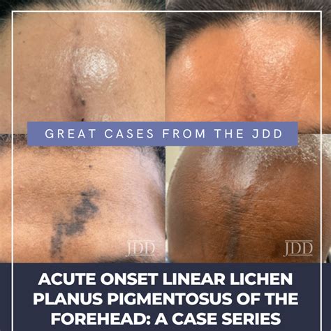 Acute Onset Linear Lichen Planus Pigmentosus of the Forehead: A Case ...