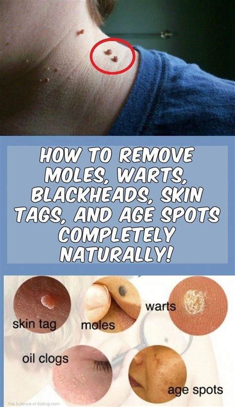 Pin on How To Remove Warts Naturally