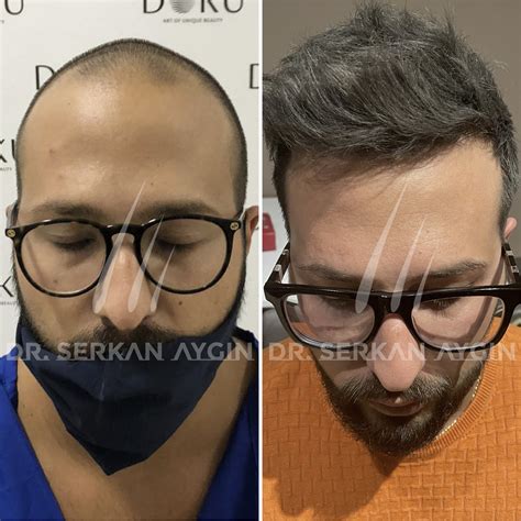 Hair Transplant in Turkey: Before and After – A Detailed Overview - Exberliner