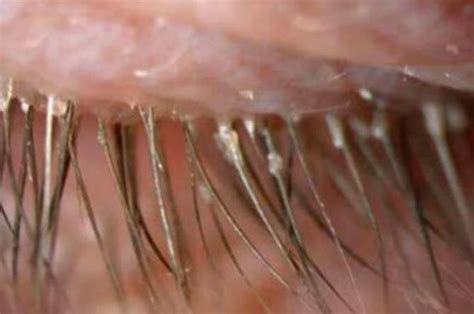 Eye Parasites: Over 100 Caused This Woman's Eye Itching And Redness