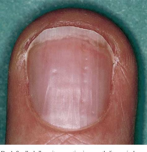 Proximal white subungual onychomycosis in the immunocompetent patient: report of two cases and ...