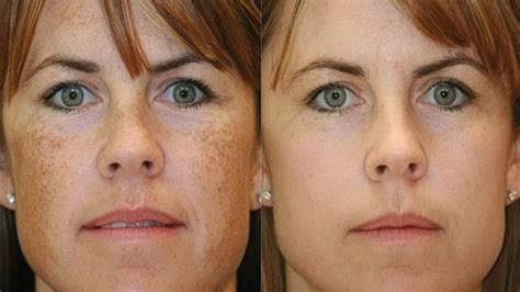Age Spots On Face Removal