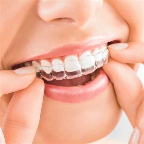 Invisible aligners - goldxoler