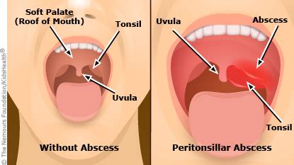 Peritonsillar Abscess | Rady Children's Hospital