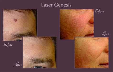 Laser Genesis in Gainesville, Florida | Dermacare Gainesville