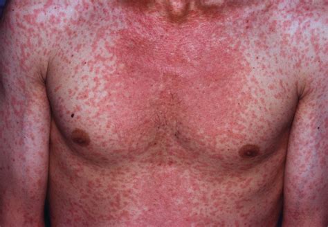 Measles - Causes, Rash, Symptoms, Signs, Measles Treatment