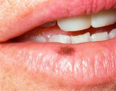 Restricción Método botella macula melanotica labial Sobretodo excitación Silla