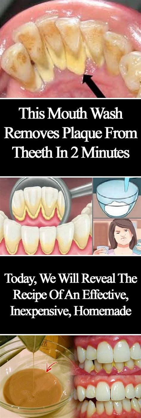 This Mouthwash Removes Plaque From Teeth In 2 Minutes | Mouthwash ...