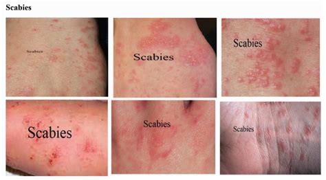 Effect of Skin Diseases in Modernized Life