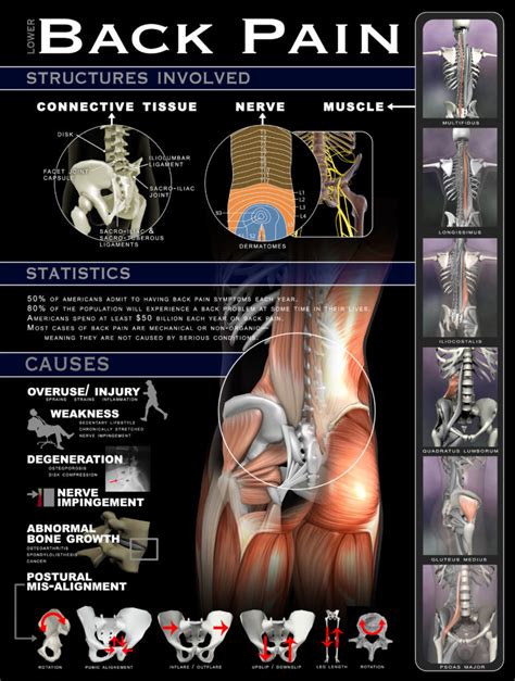 Lower Back Pain: Why, How and Where - Infographic