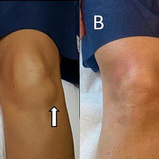 A: Preinjection knee showing ganglion cyst (arrow). B: Postinjection ...