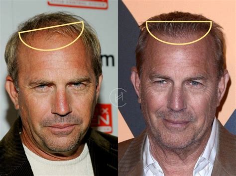 Kevin Costner Hair Transplant - Hair Loss & Technical Analysis