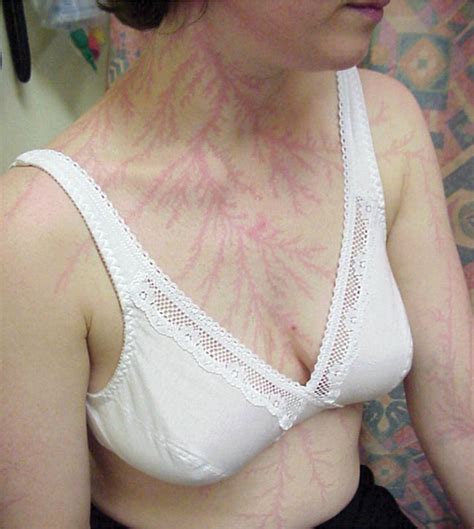 Lichtenberg Figures: The Fractal Patterns of Lightning Strike Scars » TwistedSifter