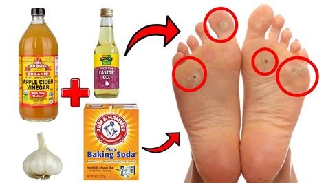 14 Proven Home Remedies For Corns & Callus Removal THAT WORK! - YouTube