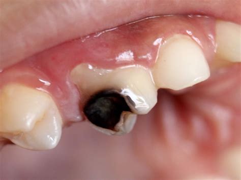 Cavities (Dental Caries). - HEALTH INFORMATION