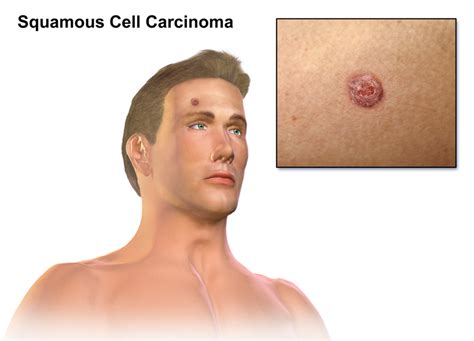 Squamous Cell Carcinoma Skin Cancer Types