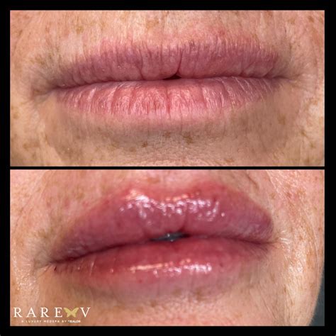 Incredible before and after results of our lip filler injection 💋 With ...