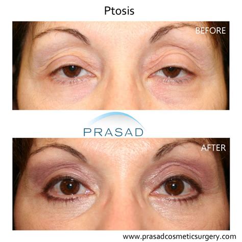 Is Ptosis Surgery Covered By Insurance - Cmea