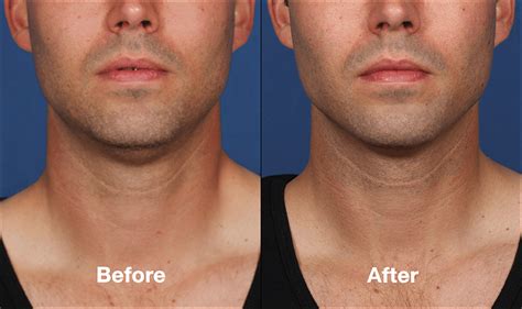 Kybella Double Chin Fat Reduction Northridge Calabasas Los Angeles