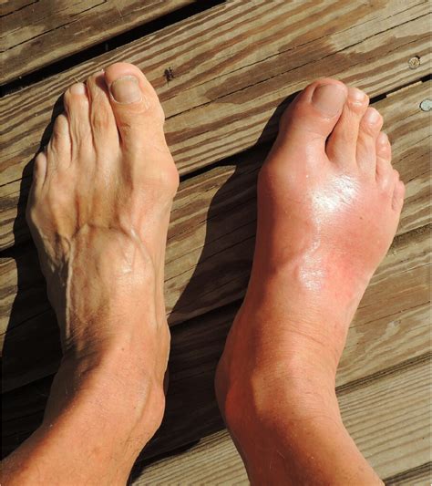 Gout Treatment Options | Eugene Foot & Ankle