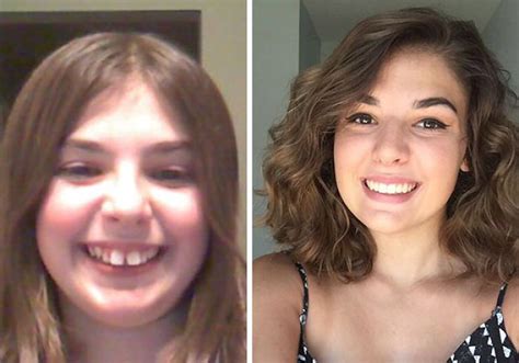 114 Incredible Before & After Transformations Of People Who Wore Braces ...