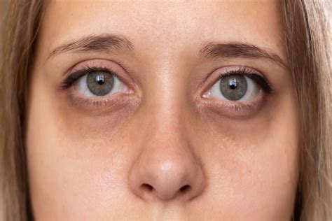 Dark Circles Under the Eyes: Causes, Treatment & Prevention | MyVision.org