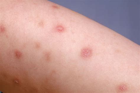 Skin Rashes In The Elderly